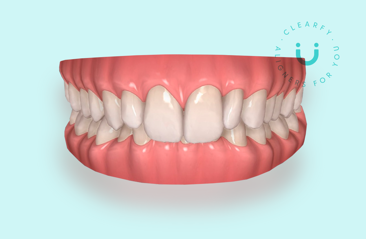 Clearfy Florida Blog Aligners